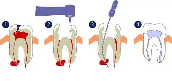 علت درد دندان پس از عصب‌کشی و پر کردن و راه‌های درمان درد
