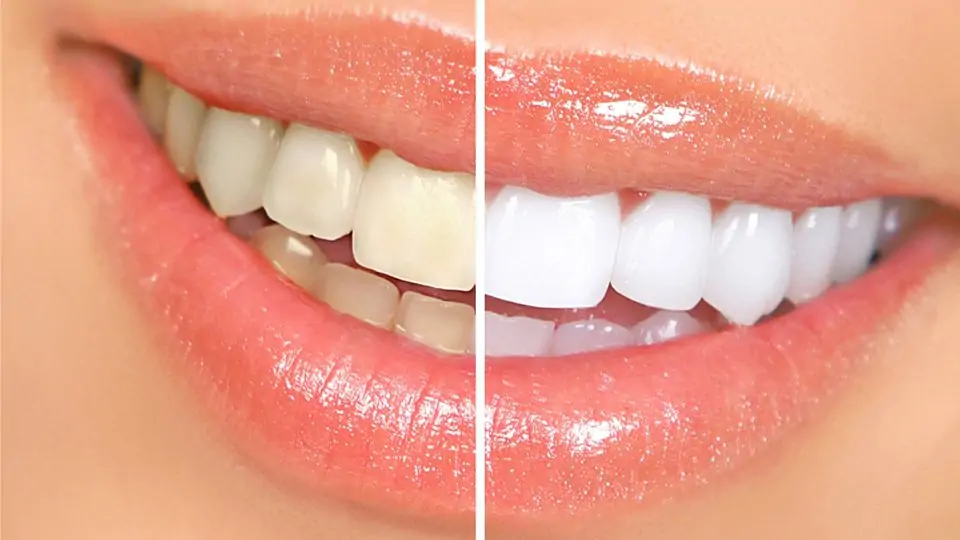 بلیچینگ دندان، روش‌ها و عوارض آن و روش‌های سفید کردن دندان در خانه