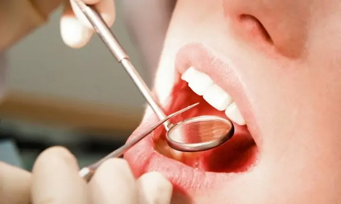 لمینت دندان چیست؟ آشنایی با مزایا و معایب انواع لمینت دندان