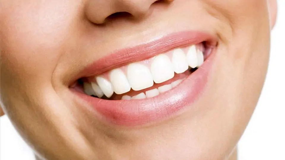 لمینت دندان چیست؟ آشنایی با مزایا و معایب انواع لمینت دندان