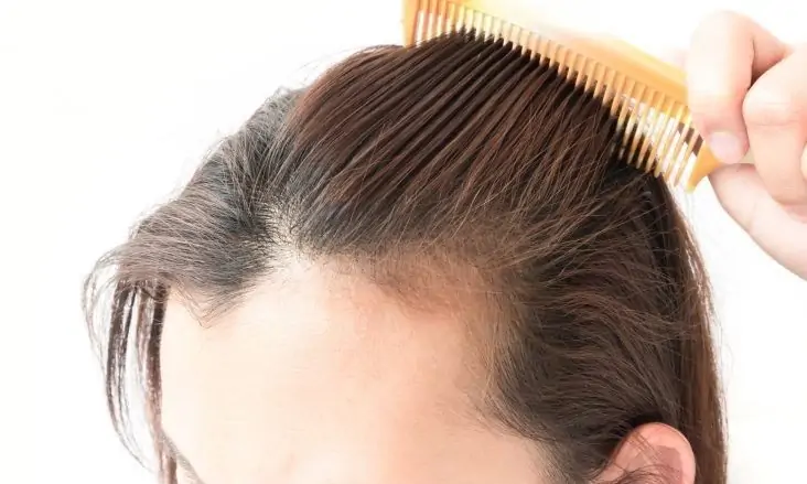 راه‌های خانگی و طبیعی برای درمان ریزش مو