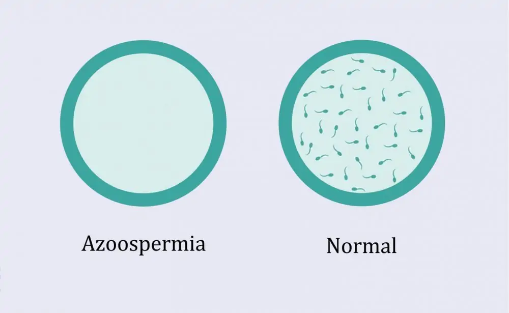 اسپرم صفر چیست و چطور درمان می‌شود؟