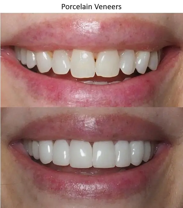 برای سفید شدن کامپوزیت دندان چه کنیم؟ روشهای مؤثر و بیخطر
