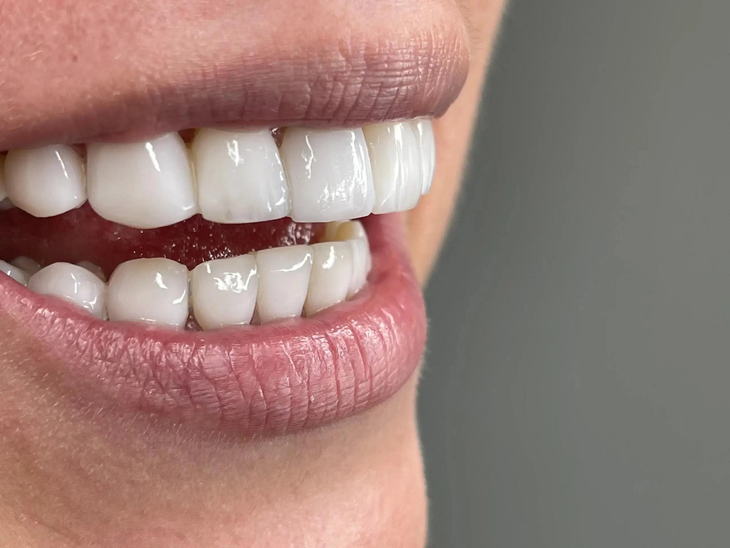 برای سفید شدن کامپوزیت دندان چه کنیم؟ روشهای مؤثر و بیخطر