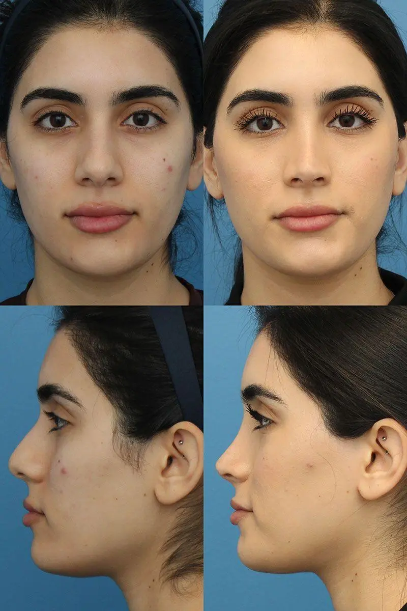 تفاوت نتیجه عمل بینی در صورت‌های مختلف؛ انتخاب مدل بینی مناسب