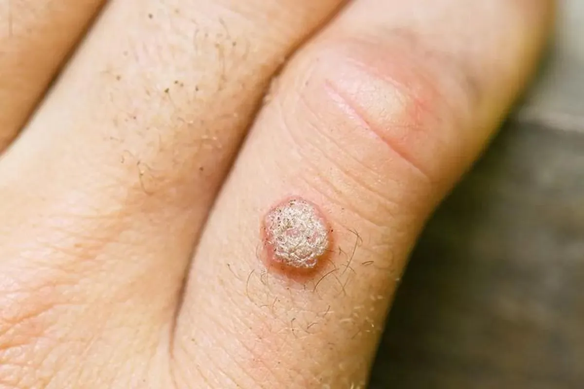 ویروس HPV چیست؟ علائم، راههای انتقال، درمان زگیل تناسلی و تقویت سیستم ایمنی
